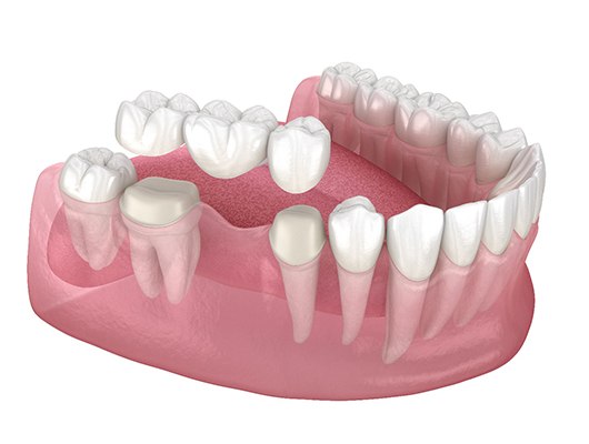 example of a traditional dental bridge in Coral Springs