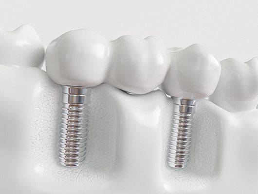 example of an implant dental bridge in Coral Springs