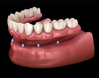 Model of implant denture for lower arch