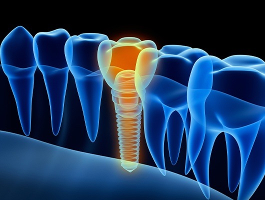 X-ray of a patient with a dental implant in Coral Springs