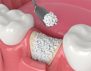 bone grafting illustration for dental implant procedure Coral Springs