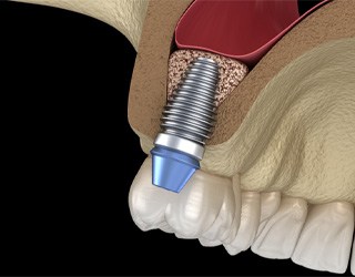 sinus lift illustration for dental implant procedure Coral Springs