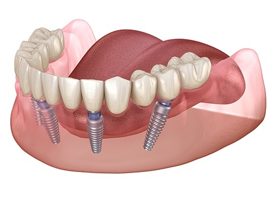 Computer illustration of all-on-4