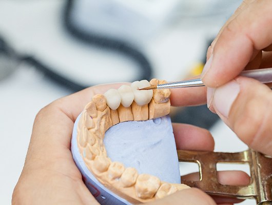 dentist working on a dental bridge in Coral Springs