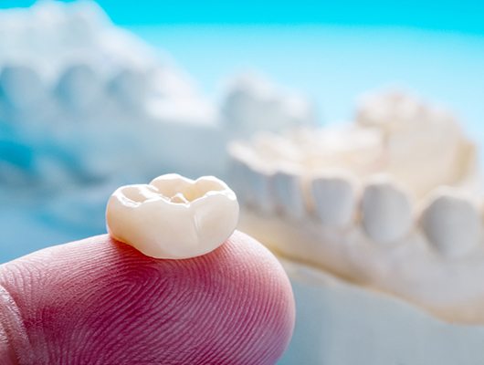 Closeup of dental crowns in Coral Springs