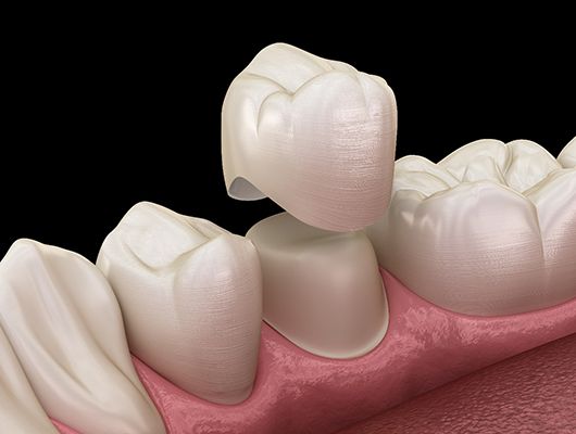 3D illustration dental crowns in Coral Springs