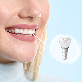 Close up of a woman smiling with a dental implant