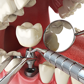 Illustration of a dental implant being placed in the lower jawbone