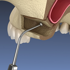 Illustration of the sinus membrane being gently lifted