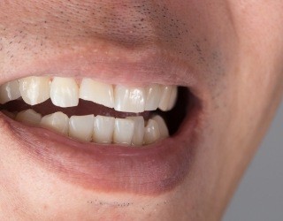man with chipped tooth