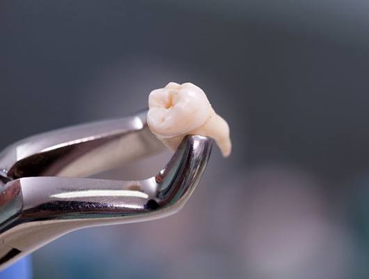 an extracted tooth held with dental forceps