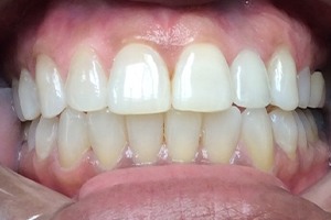 implant crowns casr