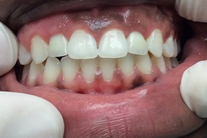 implants crowns case after