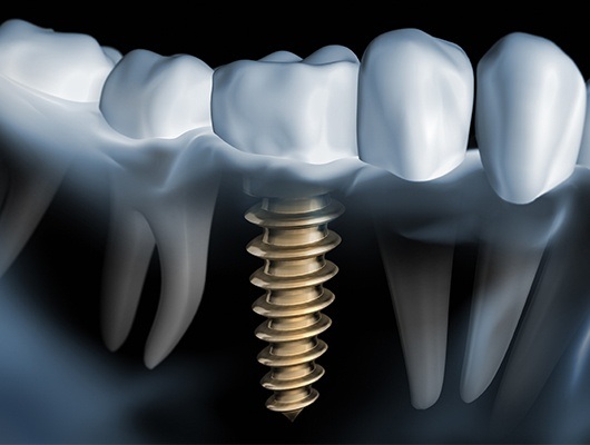 illustration of screw implant