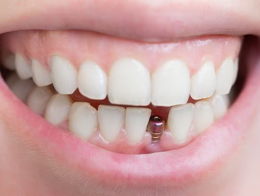 implant in bottom of smile