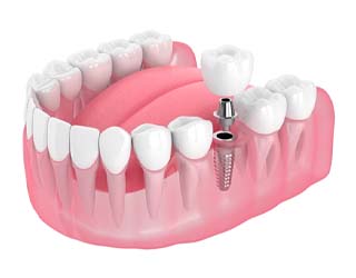 two dental implants supporting a dental bridge