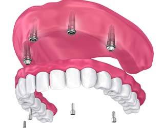 four dental implants supporting a full denture