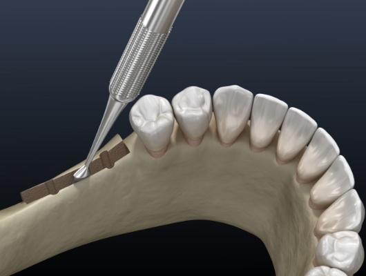 woman having laser periodontal therapy done