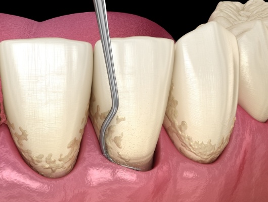 Coral Springs dentist performing scaling