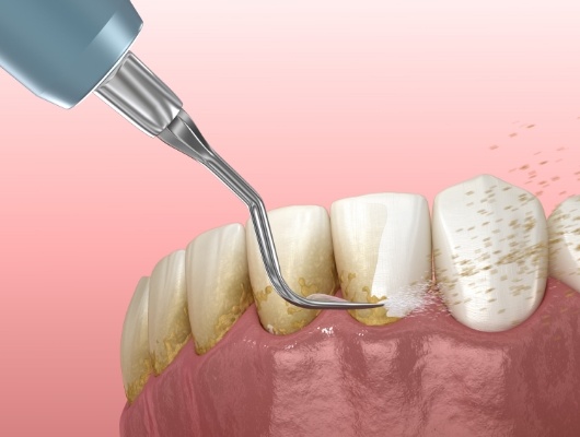 Computer illustration of dental cleaning