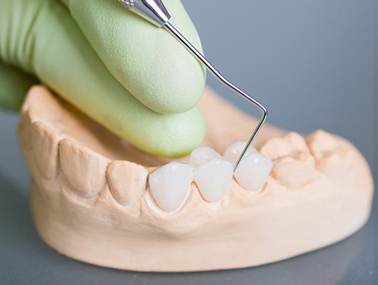 mock up of dental bridge