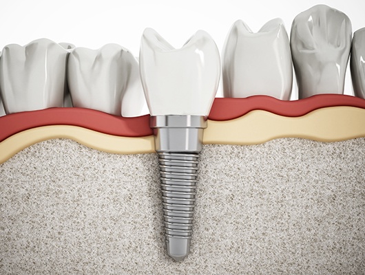 Computer illustration of dental implant in bone