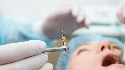 dental Implant salvage can replace your dental implant after healing