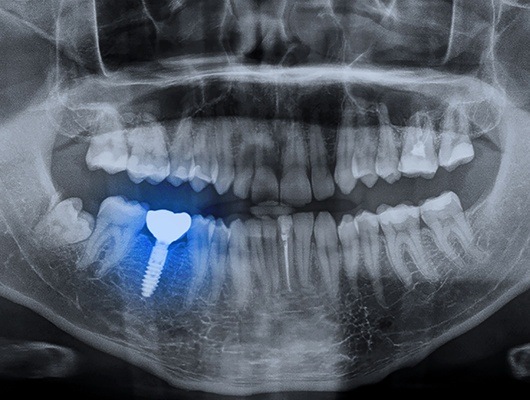 x-ray with blue teeth