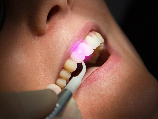 soft tissue laser