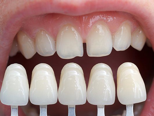 5 veneers in front of teeth