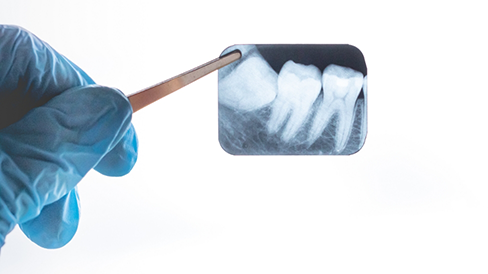 Dentist gesturing to an x ray of teeth