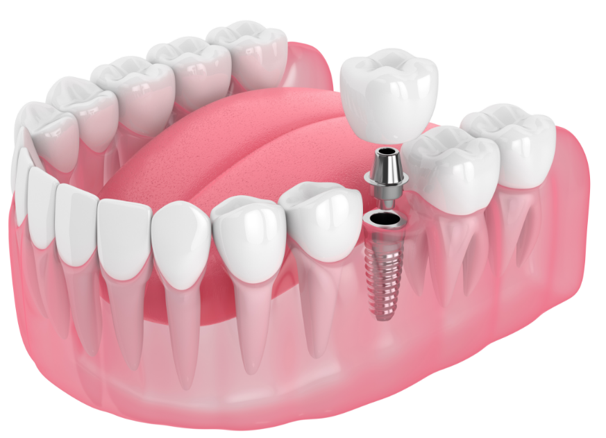 Illustration of a dental implant