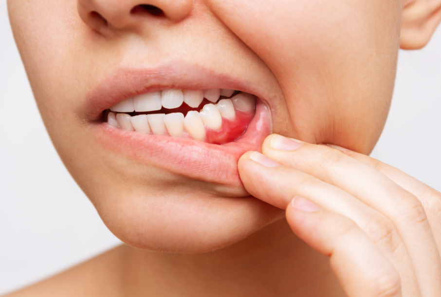 Close up of woman's inflamed gums